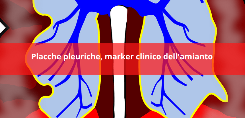 placche pleuriche